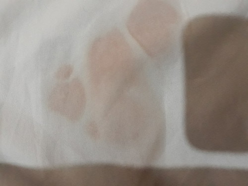 my dugo at discharge na brown