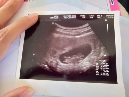 อัลตาน์ซาวน์