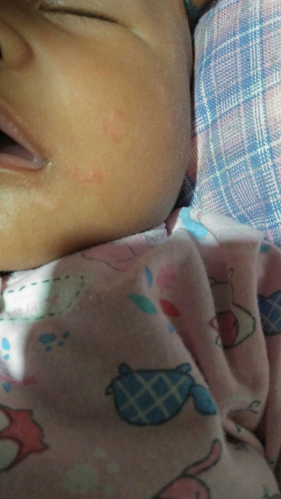 bercak putih dimuka bayi