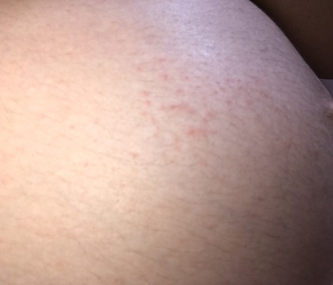 มีผื่นแดงๆเม็ดเล็กๆขึ้นแบบนี้อันตรายมั้ยคะ??