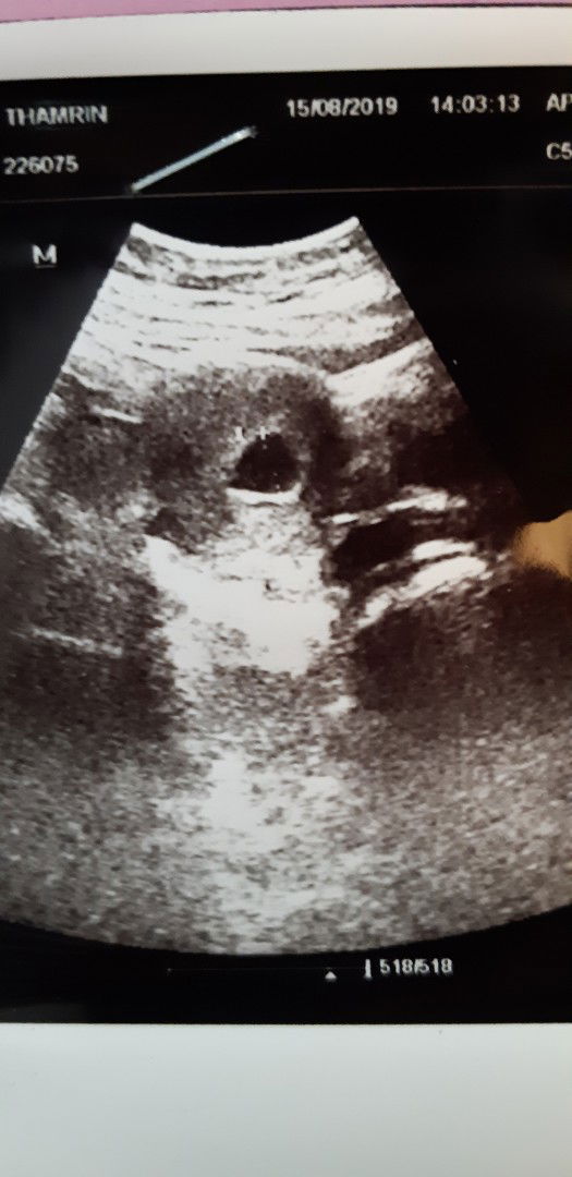 usg di usia 6 minggu, belum ada kelihatan