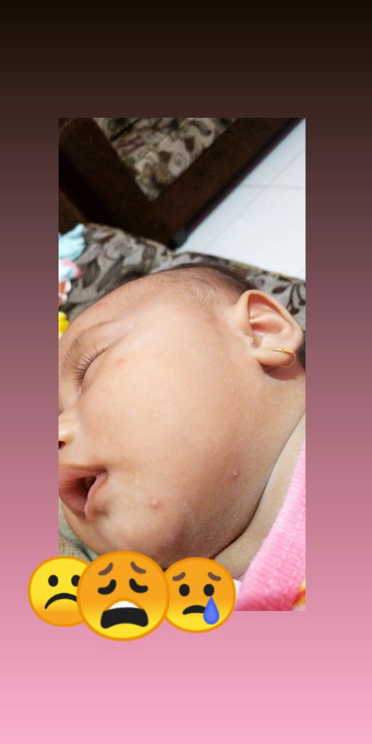 cara cepat menghilangkan bekas gigitan nyamuk