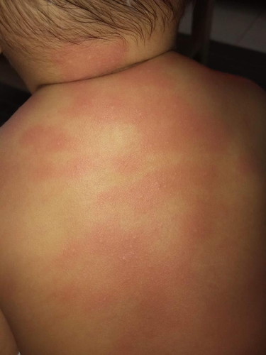 Allergies to body wash - Cetaphil with Aloe Vera and Almond Oil