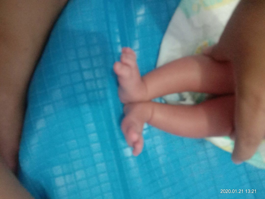 kaki anak saya bengkok