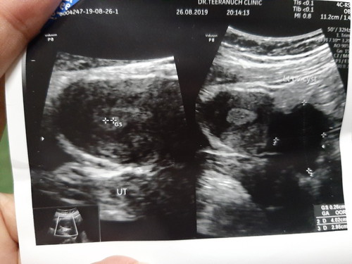 หมอแจ้งอาจเป็นถุงตั้งครรภ์ ??