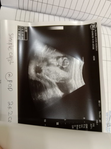 Cyst 2.0cm