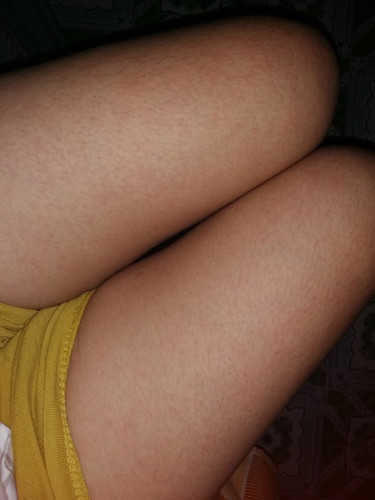 Rashes Sa Pagbubuntis