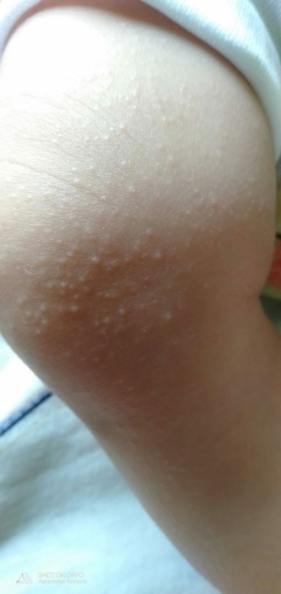 bruntusan di dengkul baby