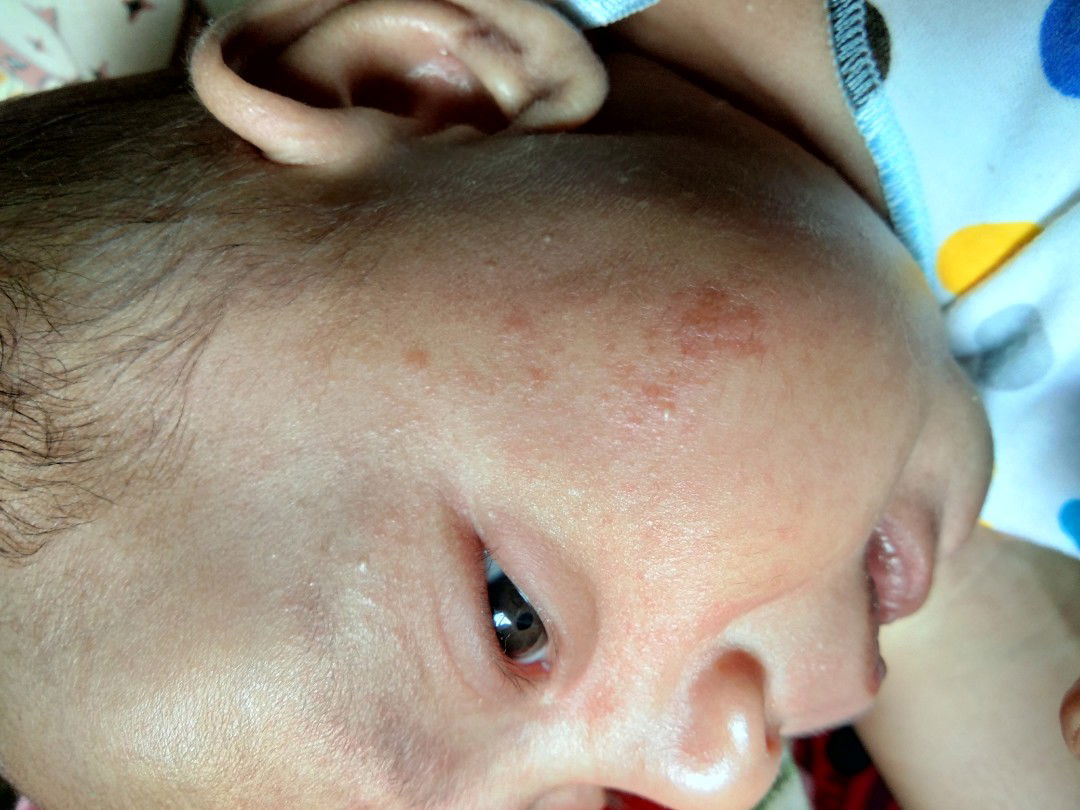 ruam/kemerahan di pipi dan sekitar mata anak