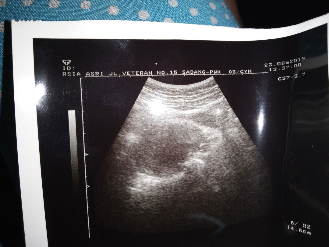 keluar darah berwarna kaya haid