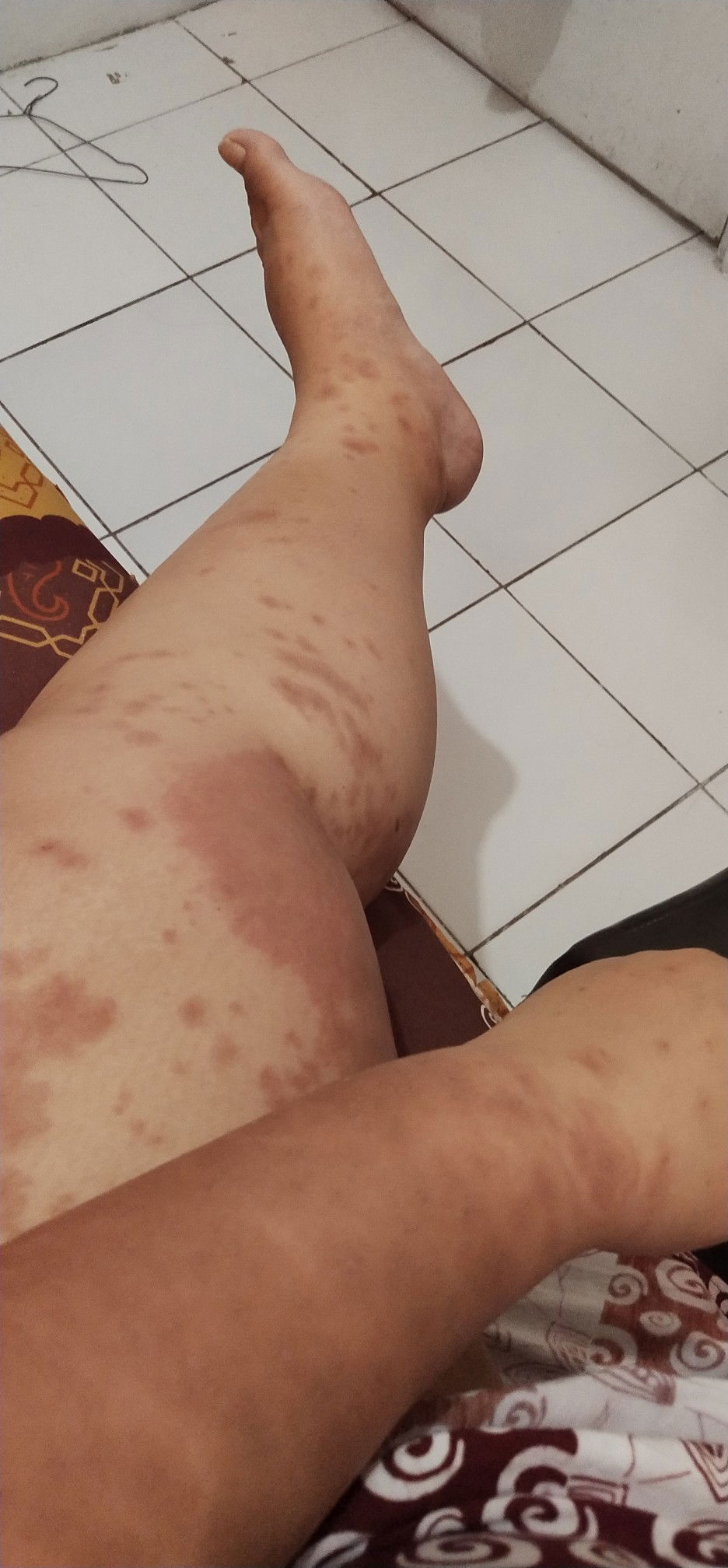 ruam gatal saat hamil