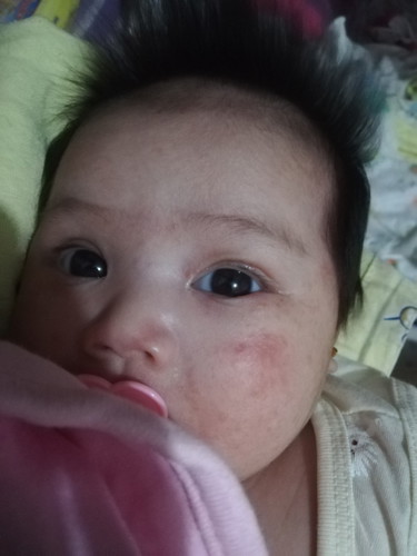 Rashes Sa Mukha
