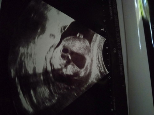 หัวใจผิดปกติ