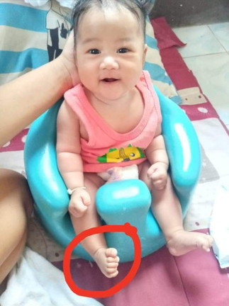 ลูกน้อยเท้าบิด