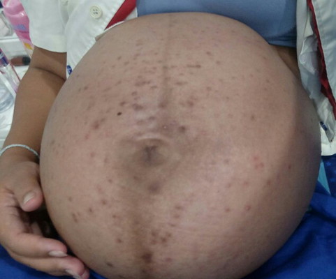 สิวขึ้นท้อง