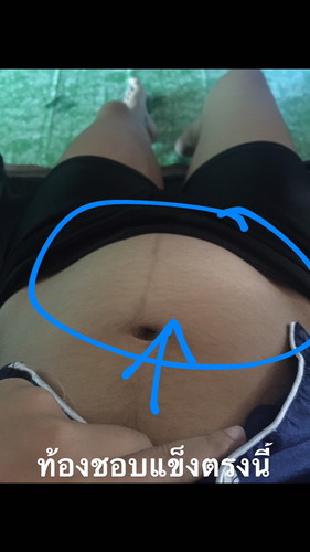 ท้องชอบแข็งนูน
