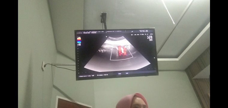 Lilitan di leher janin