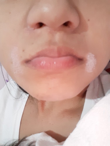 allergy