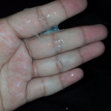 มูกเลือด