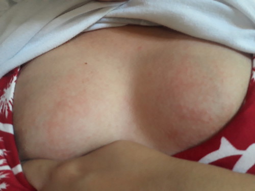 Rashes or Allergy or what?