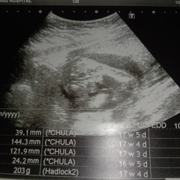 แม่ๆช่วยดูให้ค่ะ ว่าลูกนอนอยู่ท่าไหน?