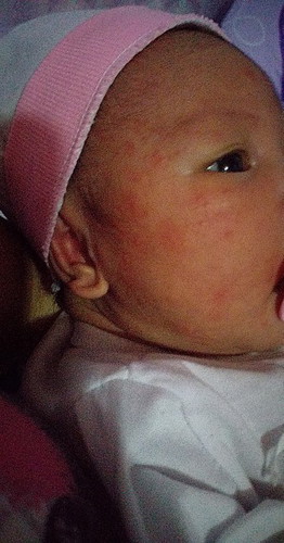baby acne