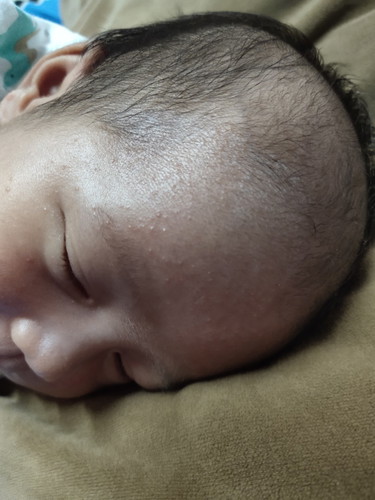 แบบนี้เค้าเรียกว่าผดอะไรคะ??