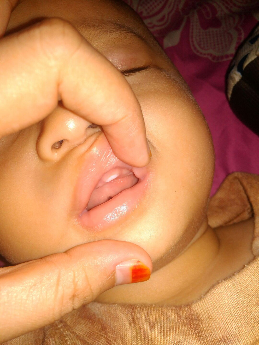 Gigi Atas Tumbuhnyaa kok 1 Ya???