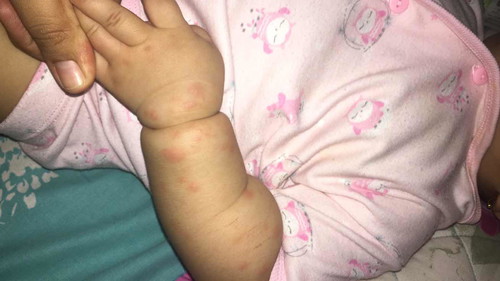 UDAH 2 MINGGU KAYAK GINI, udah dikasih cinolon & sudocream tapi belom ilang :( sempat ilang sih kemaren cm muncul lagi :( ada yang tau ini kenapa?