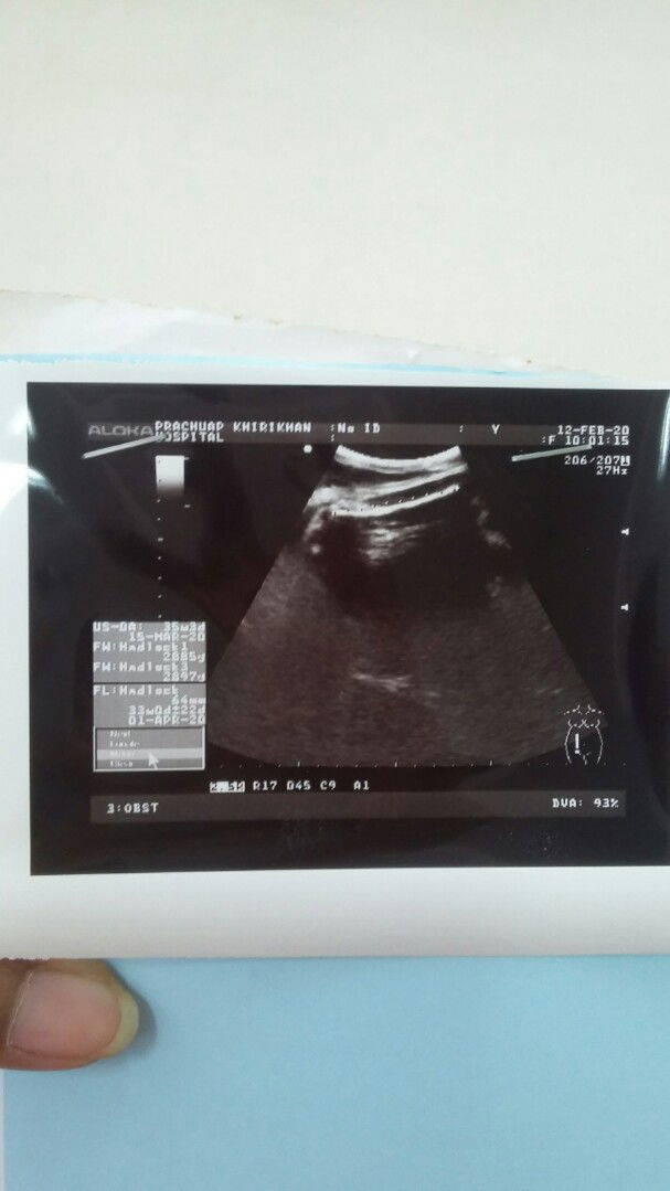 อัลตราซาวร์