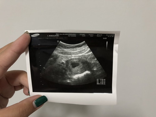 ซาวน์ตอน 6 weeks เจอถุงน้ำไม่เจอลูก
