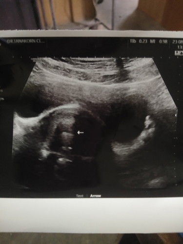 รบกวนแม่ๆอายุครรภ์5-6สัปดาห์หน่อยคะ