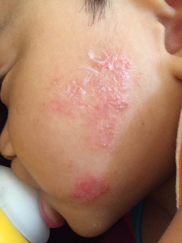 ผื่นคันบนหน้า มีวิธีแนะนำมั๊ยค่ะ