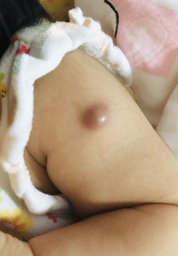ปลูกฝีแรกเกิด