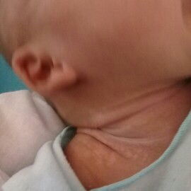 ตอนแรกคอน้องเป็นผื่นร้อนคะพอหายแล้วแต่เป็นแบบนี้คะ