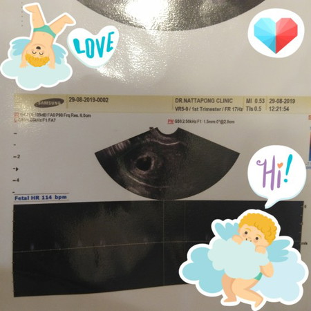 ดีใจสุดๆะ 6w u/s เจอหัวใจลูกเต้นแล้วคะ