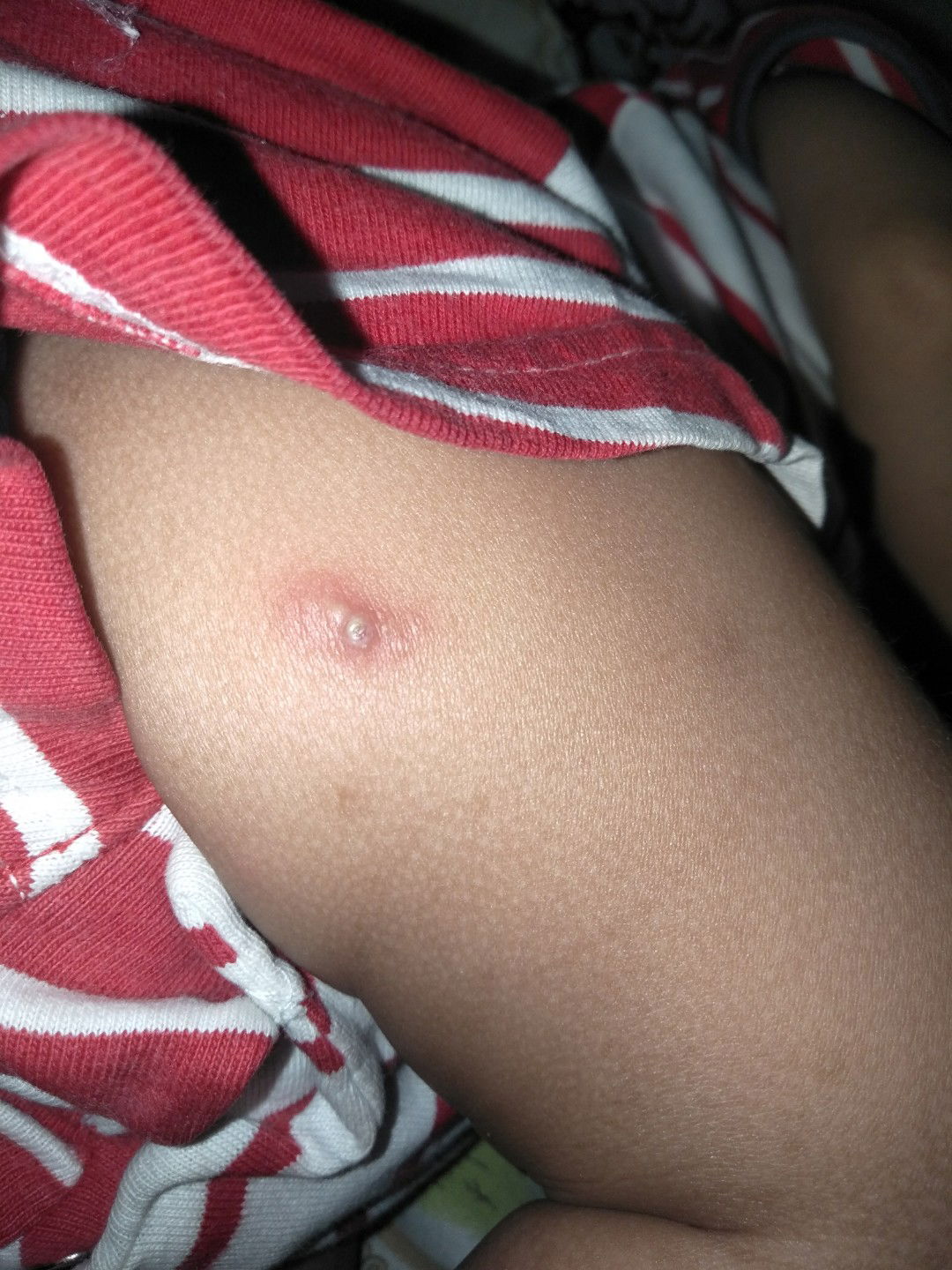 bengkak di selangkangan