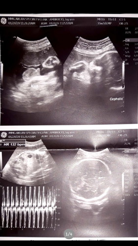 Breech to Cephalic