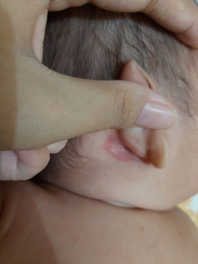 Kulit merah pada bayi