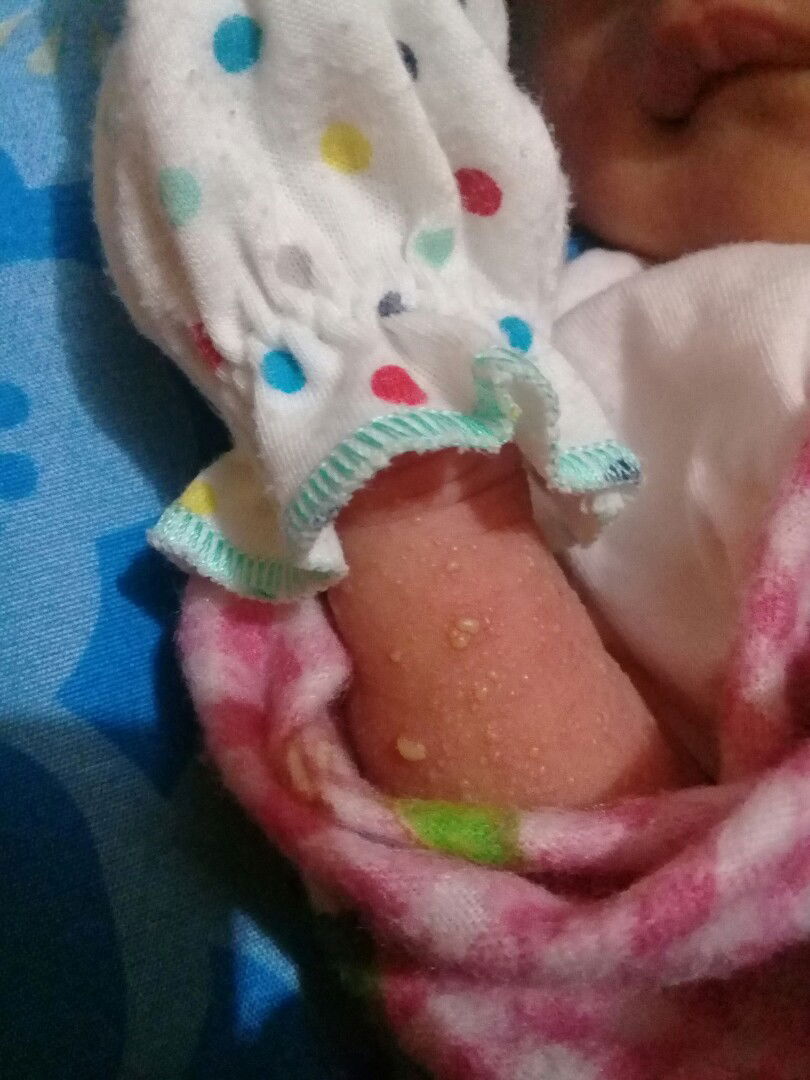 kulit bayi 14hri