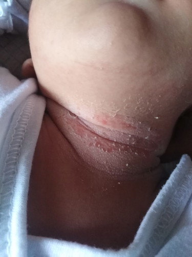 Rashes