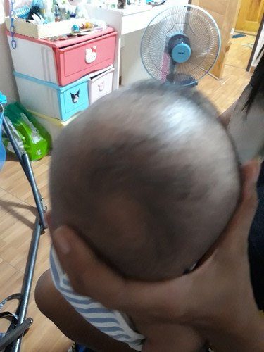 ผมลูกขึ้นแบบนี้ ตรงขวัญ มีโอกาสเป็นผมจุกมั้ยค่ะ