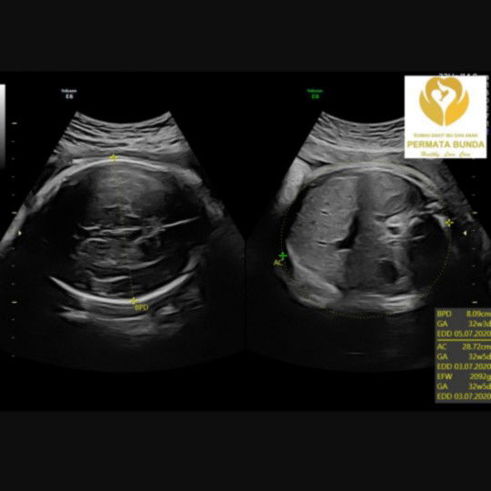 bayi sudah masuk panggul kapan lahiran nya?