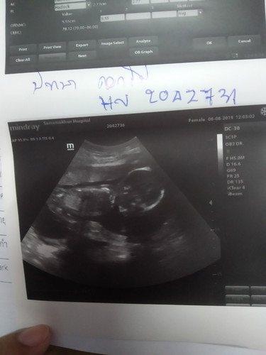 ทำไมท้องได้6เดือนกว่าลูกไม่ค่อยดิ้นค่ะแต่จะชอบปั้นตัวบ่อยมากค่ะ