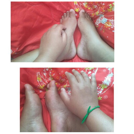 การบวมของคนท้อง