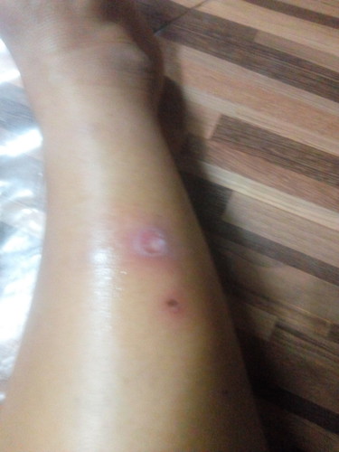 แผลไม่หายสักที