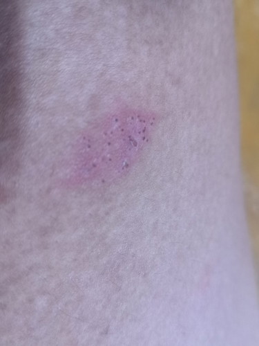 Rashes?