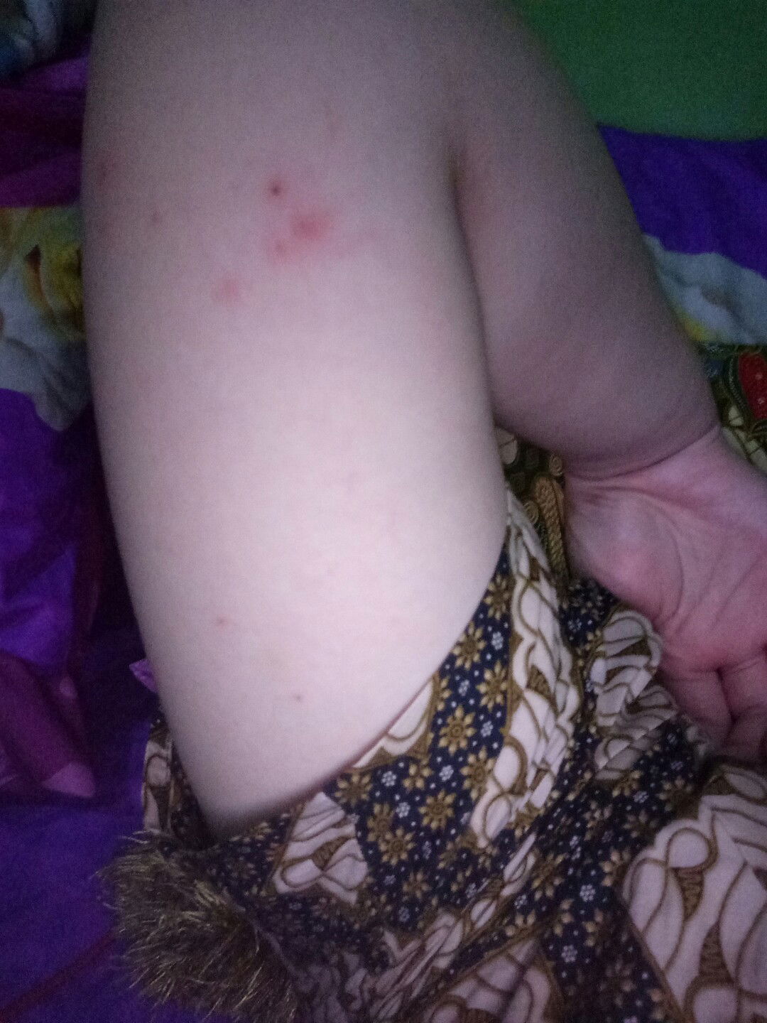 Gatal-gatal melenting berair