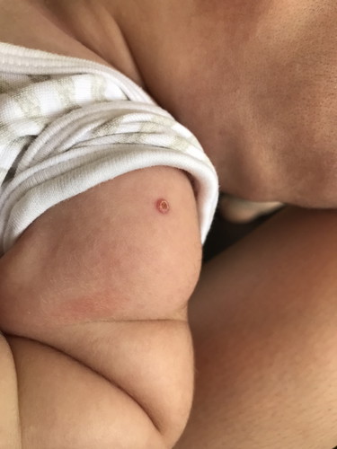 ปลูกฝีที่ไหล่ตอนแรกเกิด