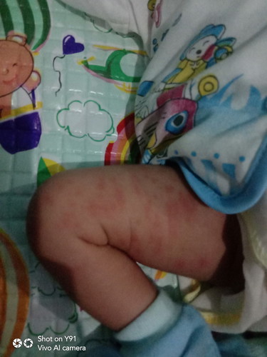 bentol merah pada bayi